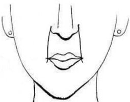 Cheek Lines When Smiling, Fa Ling Lines, Nasolabial Folds, Laugh Lines 